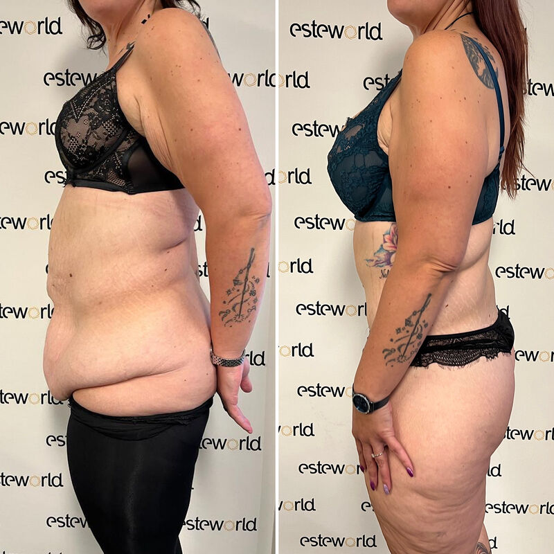 Colinda, totale make over (buikwand, lower body, borst en beenlift)