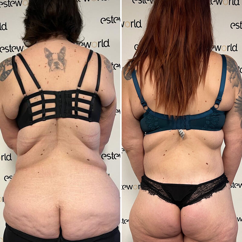 Colinda, totale make over (buikwand, lower body, borst en beenlift)