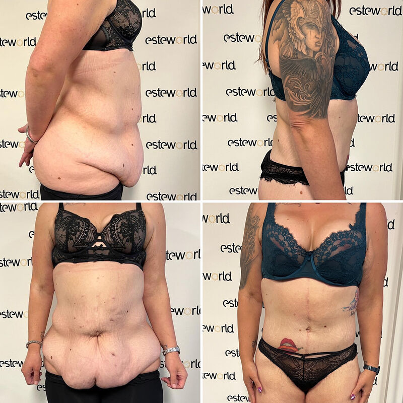 Colinda, totale make over (buikwand, lower body, borst en beenlift)