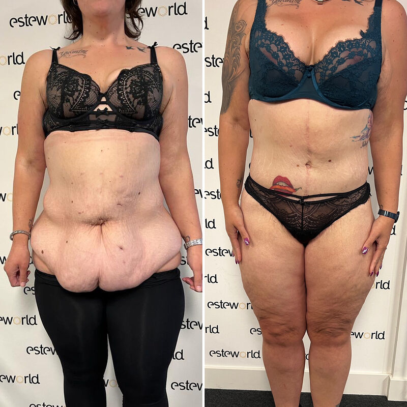 Colinda, totale make over (buikwand, lower body, borst en beenlift)