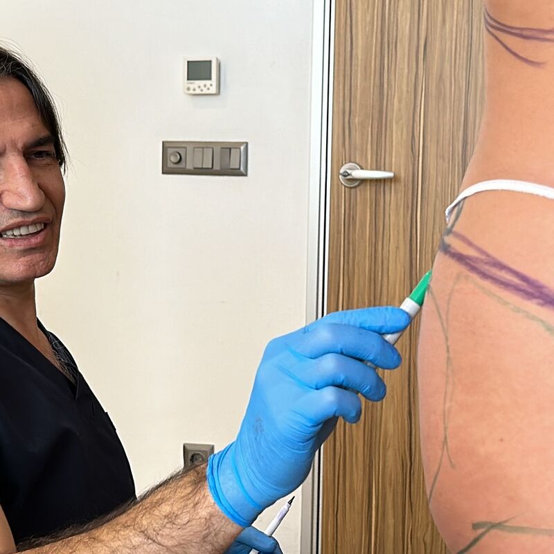 Zo happy met mijn BBL en liposuctie buik