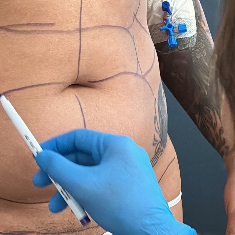 Zo happy met mijn BBL en liposuctie buik