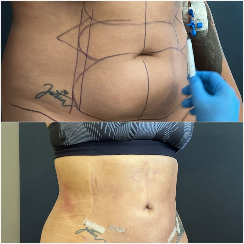Zo happy met mijn BBL en liposuctie buik