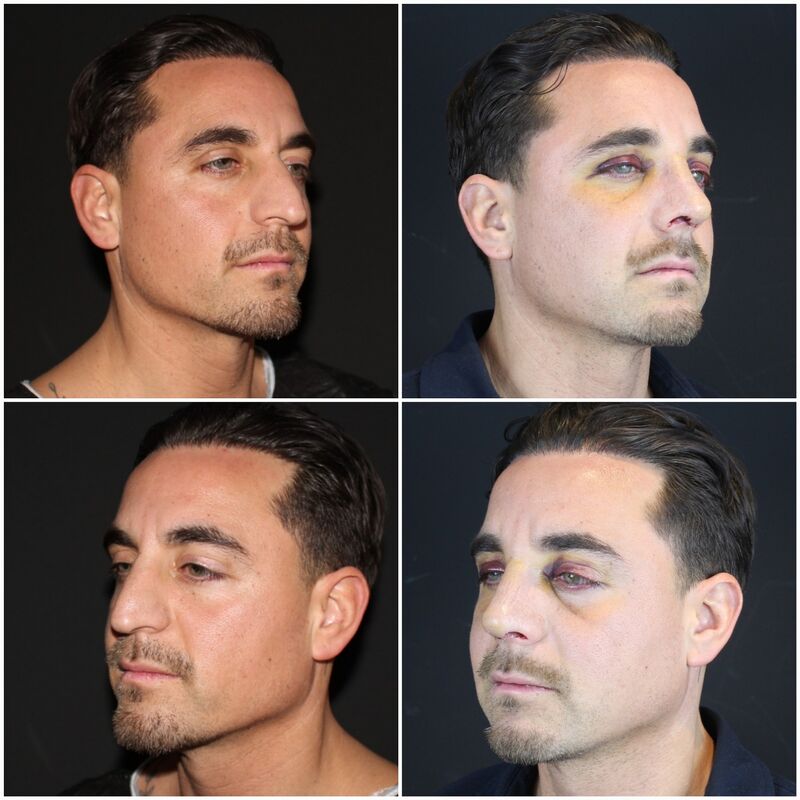 Martin, een neuscorrectie wilde ik al zo lang