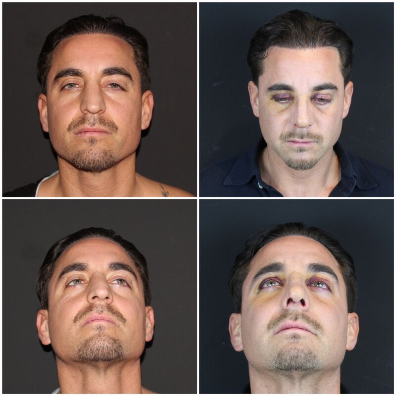 Martin, een neuscorrectie wilde ik al zo lang