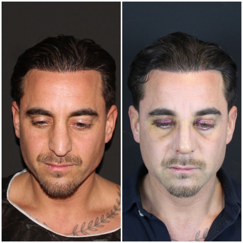 Martin, een neuscorrectie wilde ik al zo lang