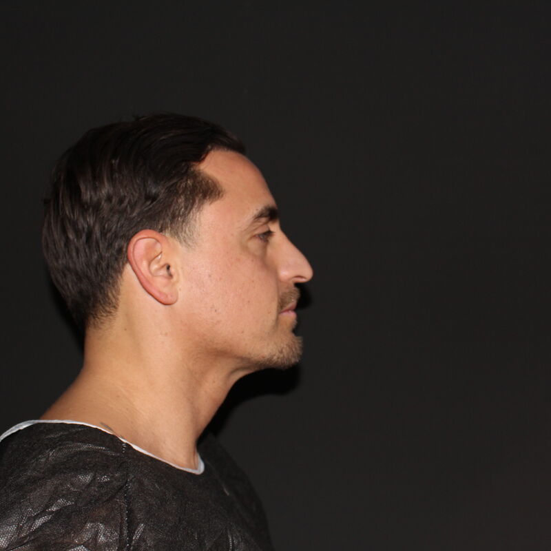 Martin, een neuscorrectie wilde ik al zo lang