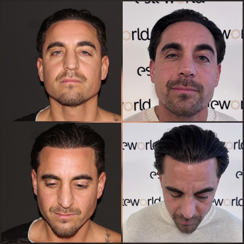 Martin, een neuscorrectie wilde ik al zo lang