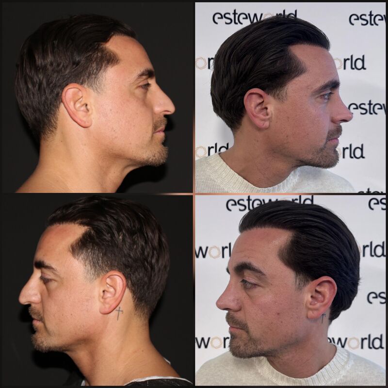 Martin, een neuscorrectie wilde ik al zo lang