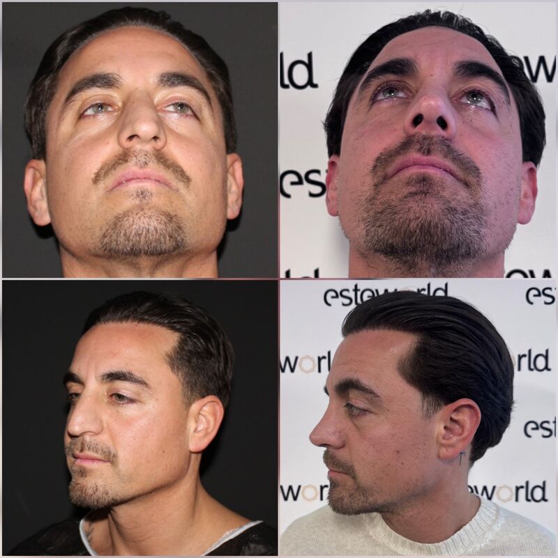 Martin, een neuscorrectie wilde ik al zo lang