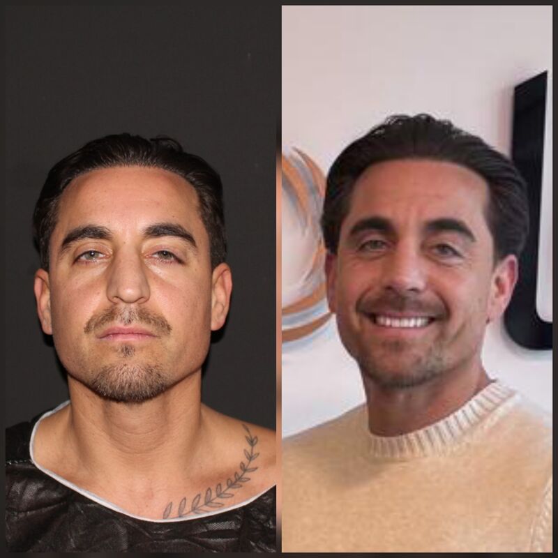 Martin, een neuscorrectie wilde ik al zo lang