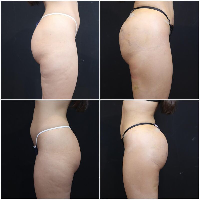 Mooie rondingen na mijn BBL, zo blij!