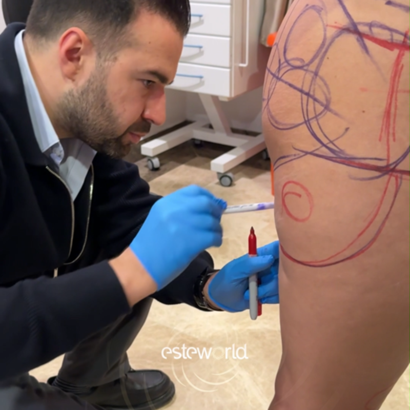 Mooie rondingen na mijn BBL, zo blij!