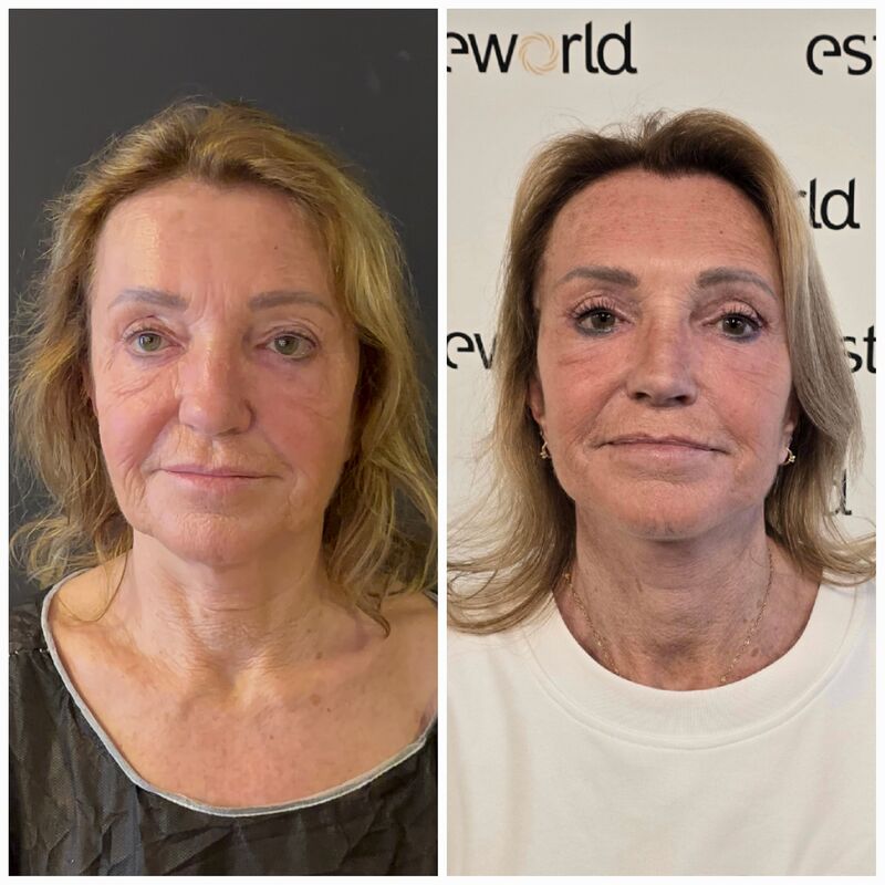 Facelift, Ik ben een vrouw van 60 met geest van 30