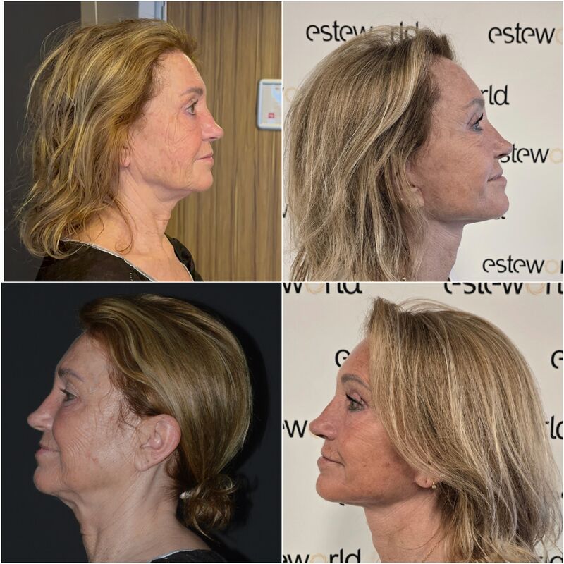 Facelift, Ik ben een vrouw van 60 met geest van 30