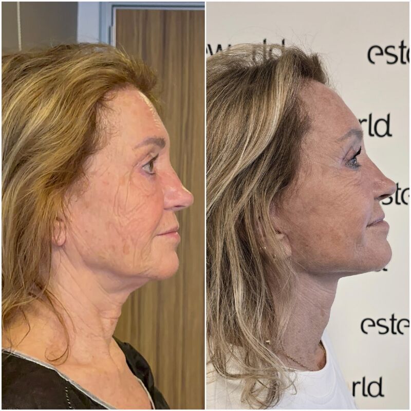 Facelift, Ik ben een vrouw van 60 met geest van 30