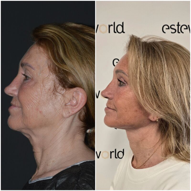 Facelift, Ik ben een vrouw van 60 met geest van 30