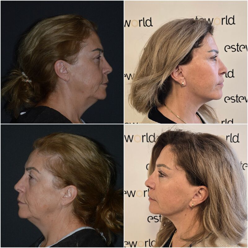Sedette, zo happy met mijn natuurlijke facelift