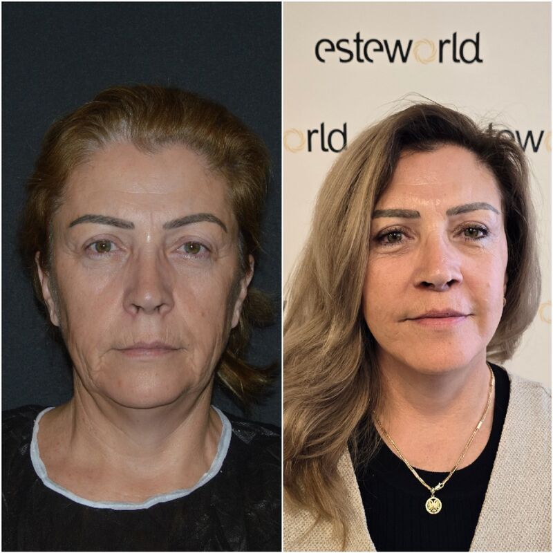 Sedette, zo happy met mijn natuurlijke facelift