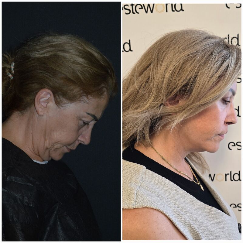 Sedette, zo happy met mijn natuurlijke facelift