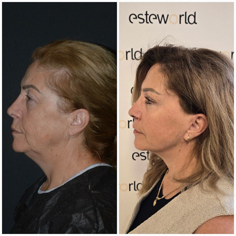Sedette, zo happy met mijn natuurlijke facelift