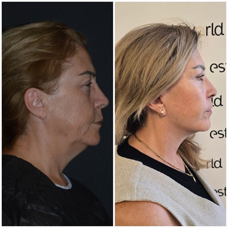 Sedette, zo happy met mijn natuurlijke facelift