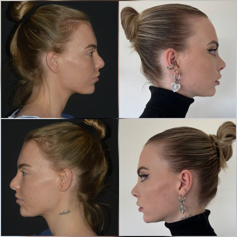 Marilena, waarom Esteworld voor mijn Neus en borsten?