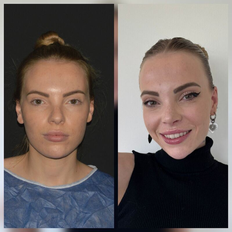 Marilena, waarom Esteworld voor mijn Neus en borsten?