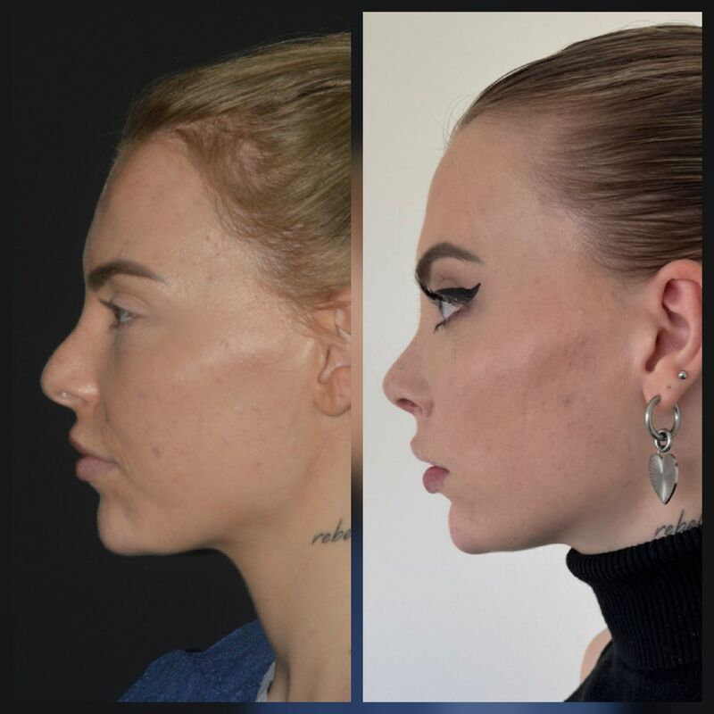 Marilena, waarom Esteworld voor mijn Neus en borsten?