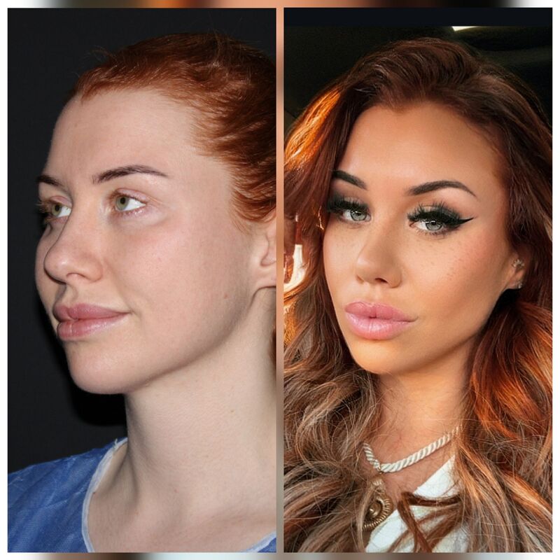 Tamara treffers neuscorrectie en temporaal lift