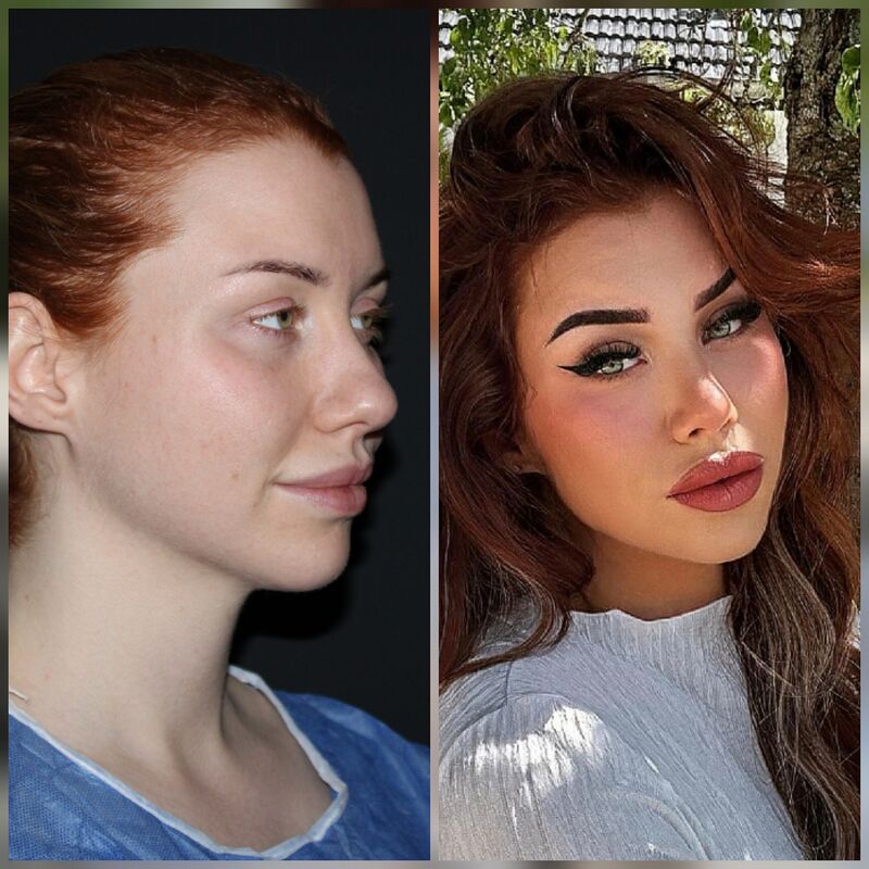 Tamara treffers neuscorrectie en temporaal lift