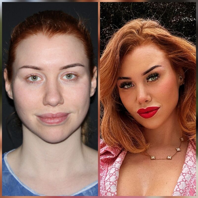 Tamara treffers neuscorrectie en temporaal lift