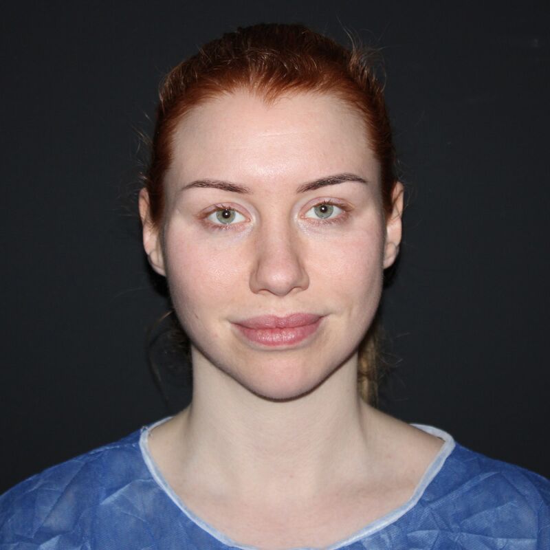 Tamara treffers neuscorrectie en temporaal lift