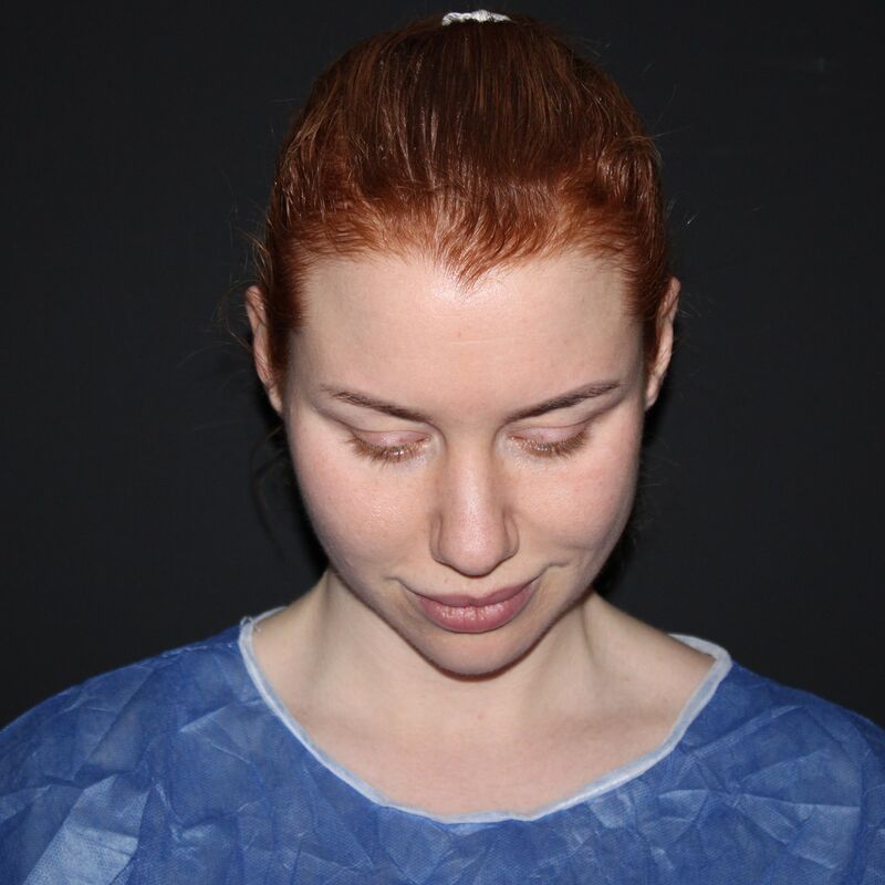 Tamara treffers neuscorrectie en temporaal lift