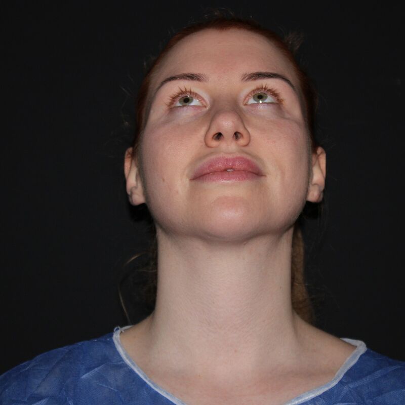 Tamara treffers neuscorrectie en temporaal lift