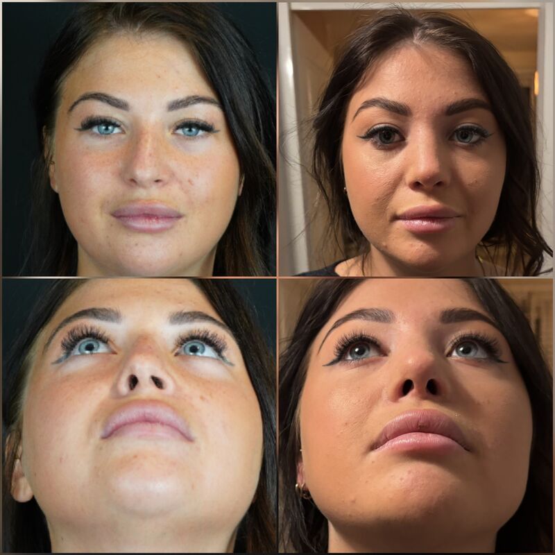 Zoe Bosch, een neuscorrectie stond op mijn wenslijstje