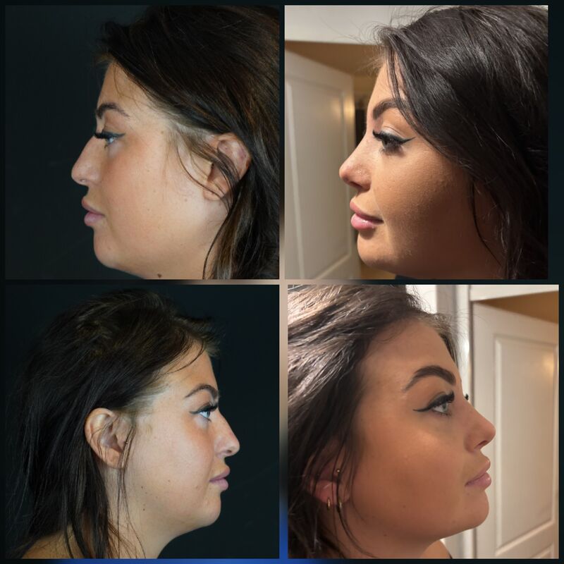 Zoe Bosch, een neuscorrectie stond op mijn wenslijstje