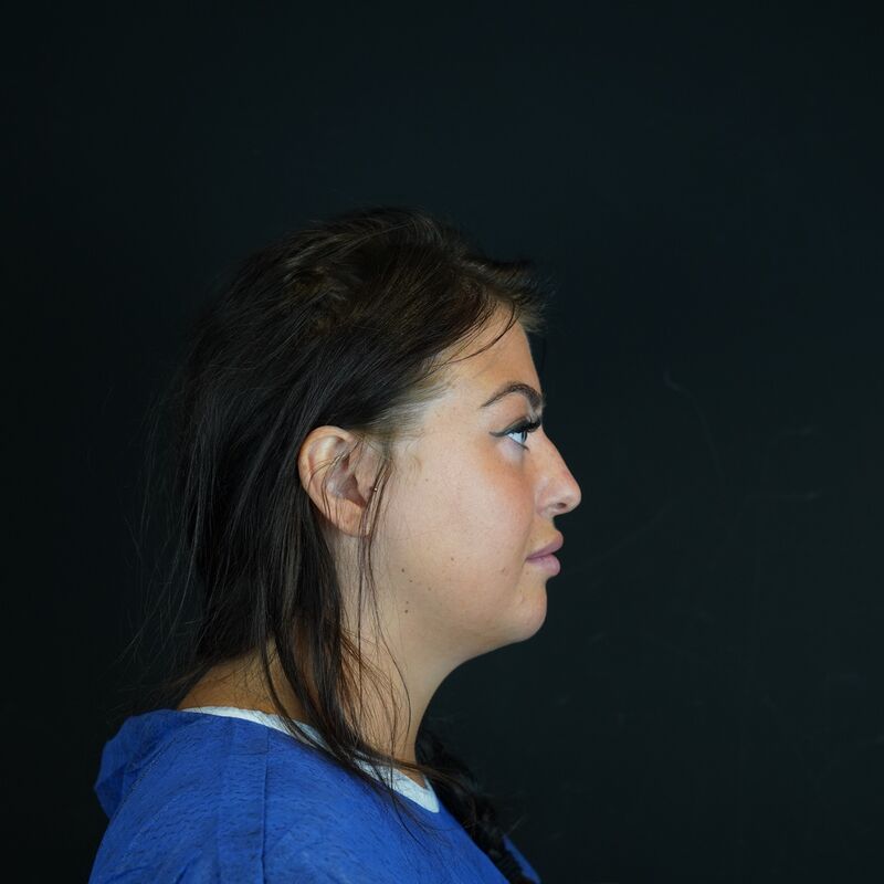 Zoe Bosch, een neuscorrectie stond op mijn wenslijstje