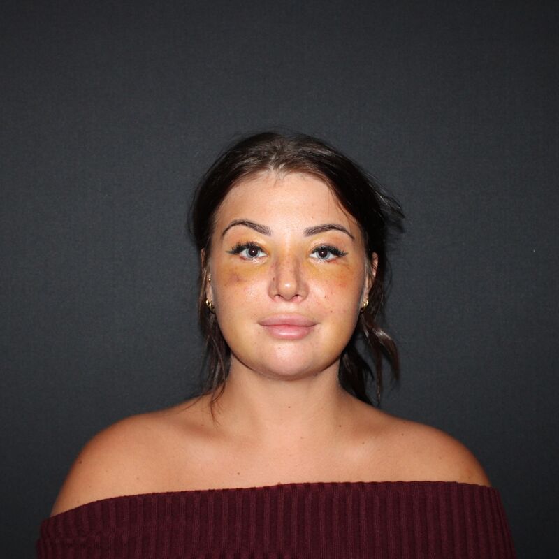 Zoe Bosch, een neuscorrectie stond op mijn wenslijstje