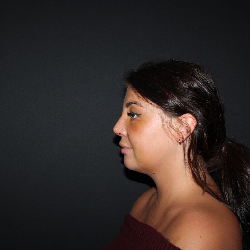 Zoe Bosch, een neuscorrectie stond op mijn wenslijstje