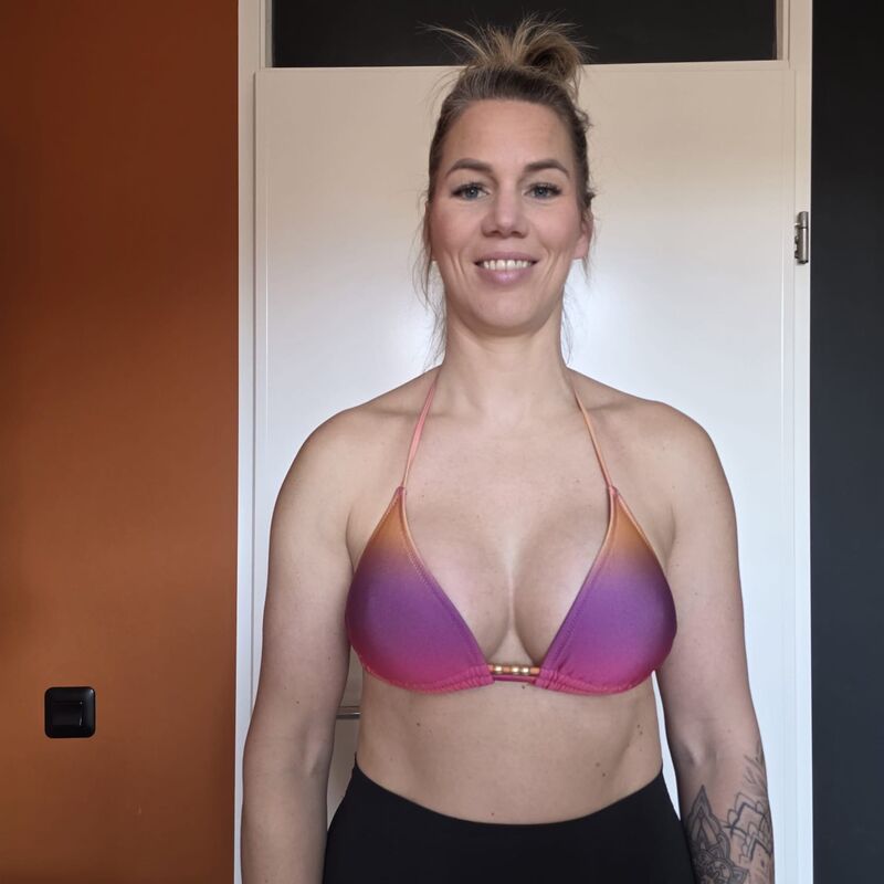 Borstlift plus prothese na 2 mislukte behandelingen in NL