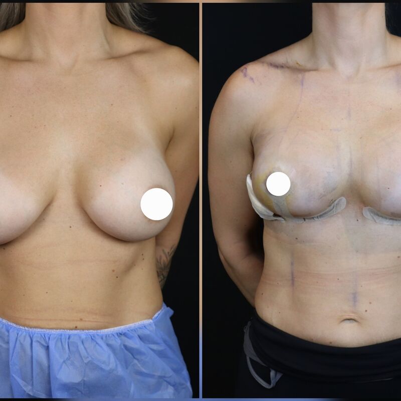 Borstlift plus prothese na 2 mislukte behandelingen in NL
