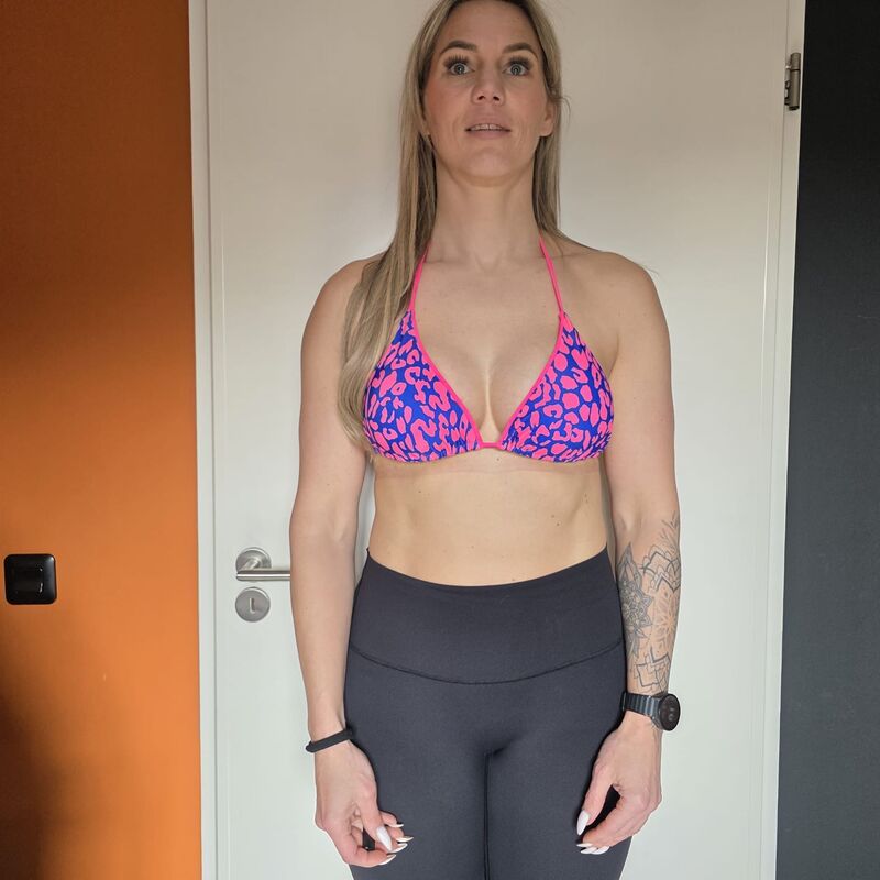Borstlift plus prothese na 2 mislukte behandelingen in NL