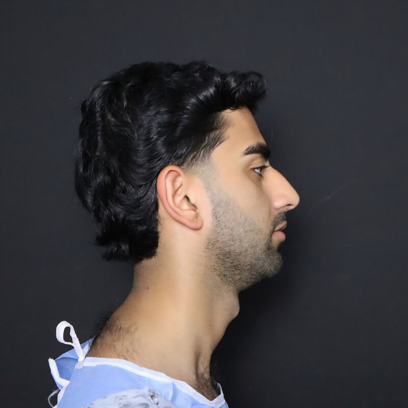 Alireza, mijn neus past nu perfect bij mijn gezicht