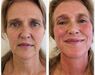 Scarlet-S (facelift zonder operatie)