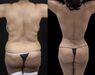 Liposuctie Turkije