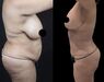 Liposuctie Turkije