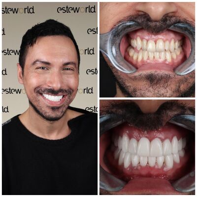 Hollywoodsmile Turkije