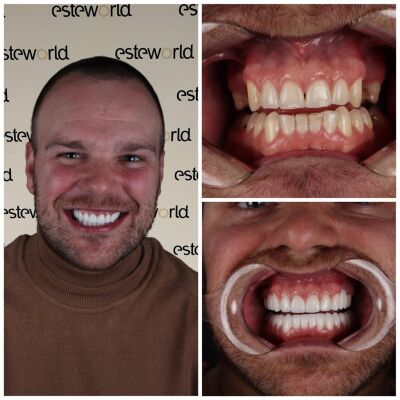 Bruggen behandeling Istanbul