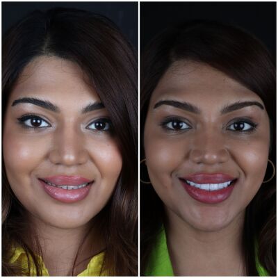 Vaste gebitsprothese Istanbul